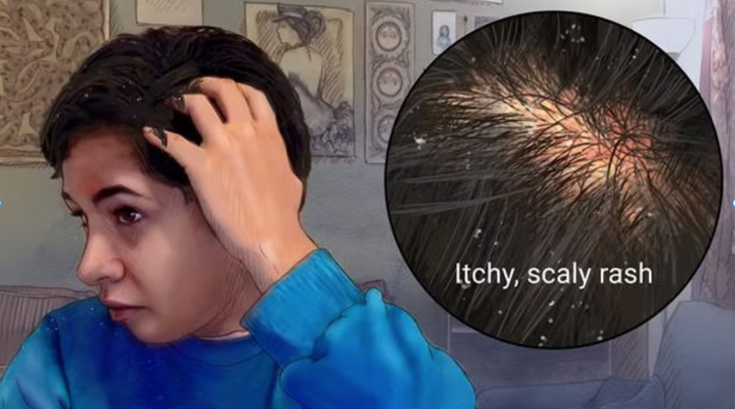 Hypochlorous Acid for Managing Seborrheic Dermatitis: A Natural Solution for Flaky, Irritated Skin