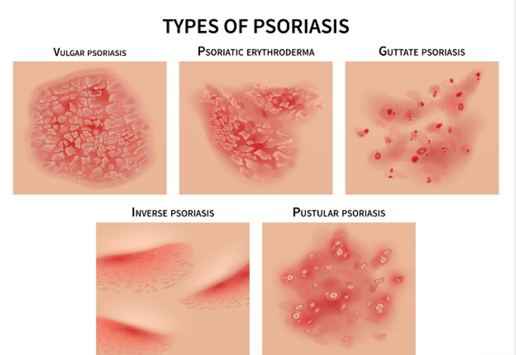 Hypochlorous Acid: A Natural Solution for Managing Psoriasis