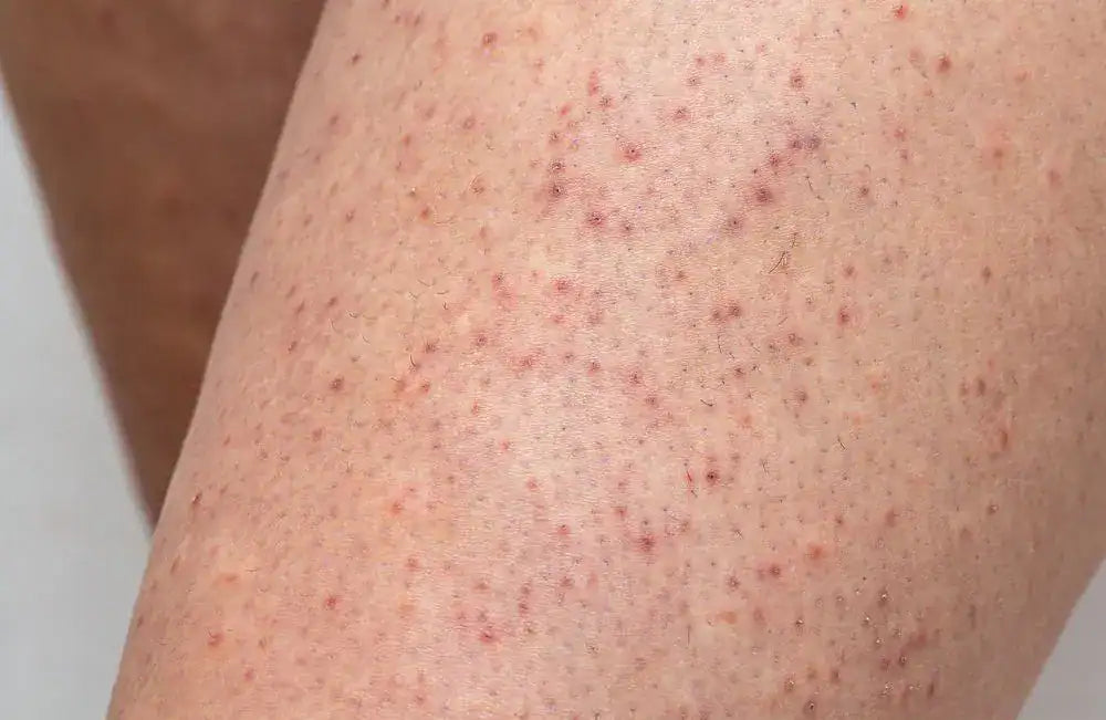 Is Hypochlorous Acid Good for Keratosis Pilaris? Here's the Truth Abou   Honeydew Labs