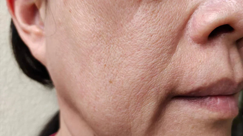 How to Get Rid of Smile Lines Without Botox: Natural, Effective Alternatives That Actually Work