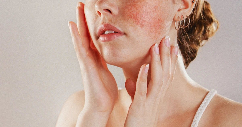 Girl with rosacea
