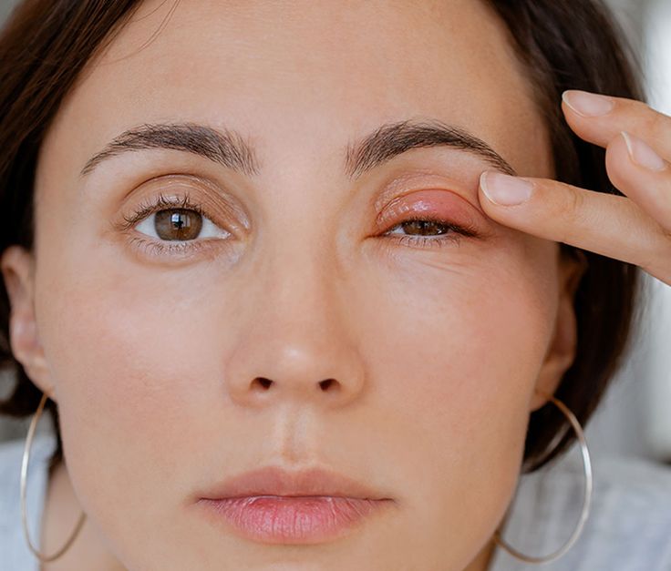 Lady with stye