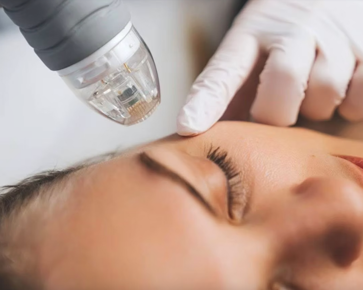 Can You Use Hypochlorous Acid After Microneedling?