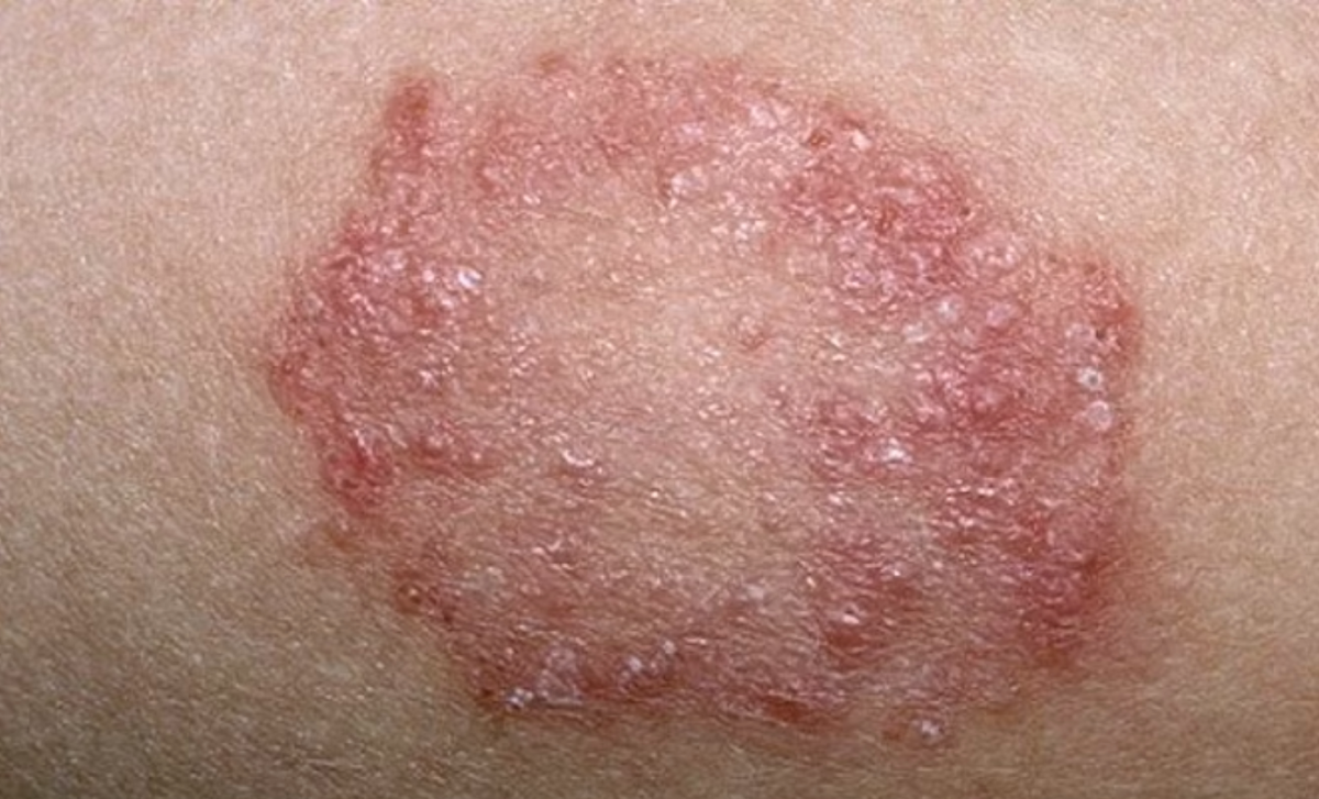 Does Hypochlorous Acid Kill Fungus?