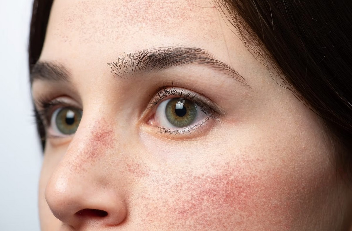 Is Hypochlorous Acid Good for Rosacea?