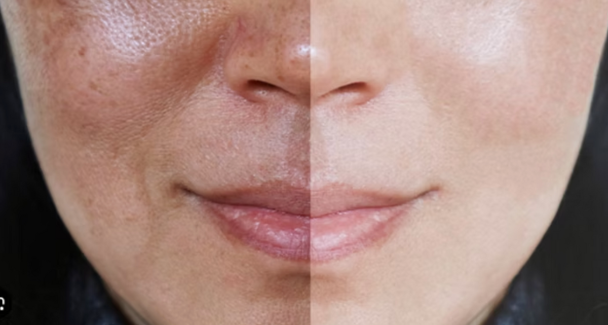 Hypochlorous Acid for Reducing Hyperpigmentation