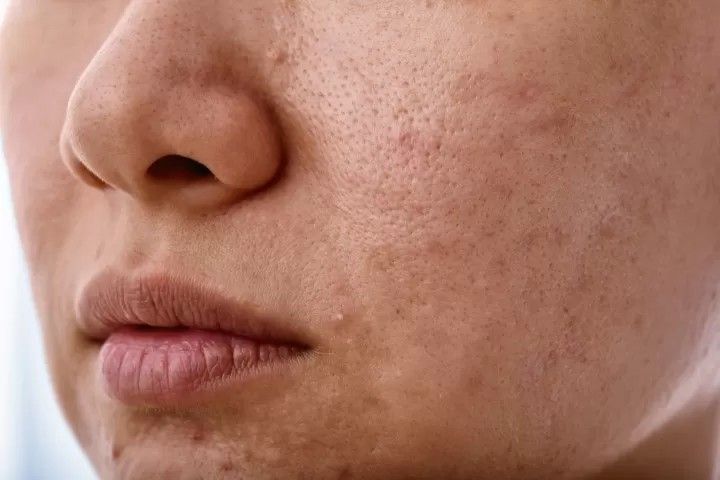 Skin with blackheads