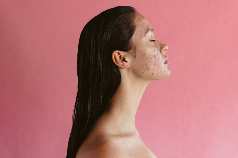 Girl with acne
