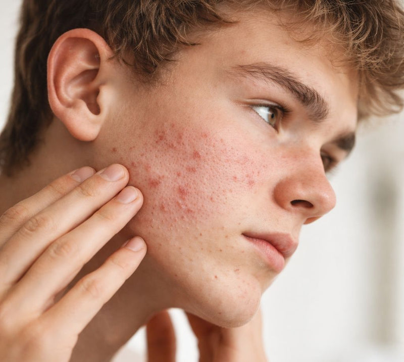 Male with acne