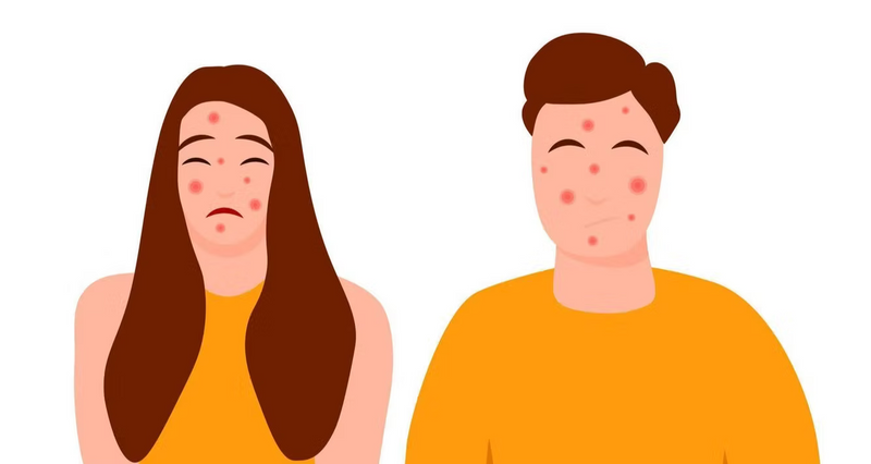 Can Hypochlorous Acid Effectively Treat Acne?