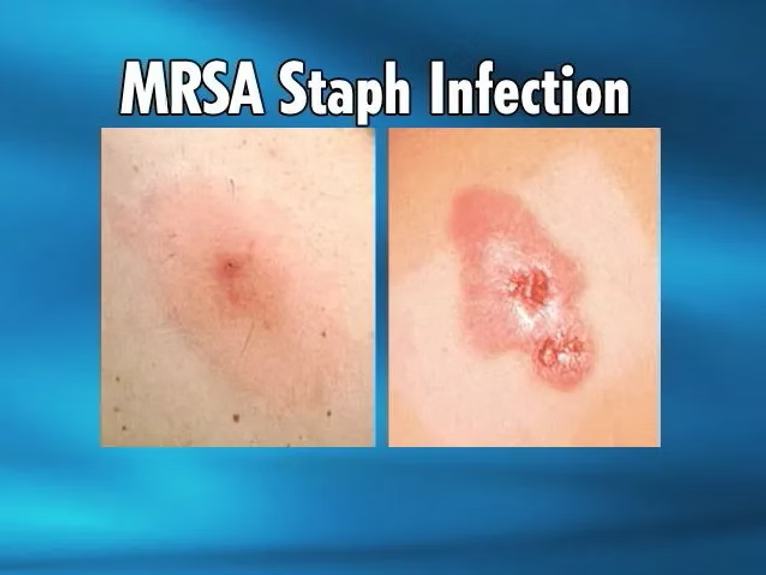 Does Hypochlorous Acid Kill Staph? Here’s the Truth