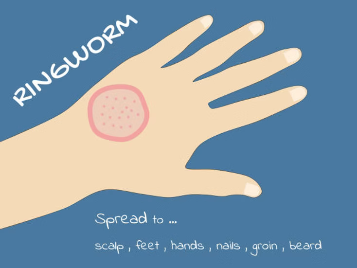 Does Hypochlorous Acid Kill Ringworm?