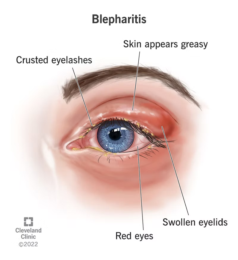 How to Use Hypochlorous Acid for Blepharitis?