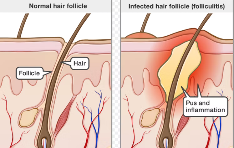 Hypochlorous Acid for Treating Folliculitis: A Safe and Effective Antimicrobial Solution