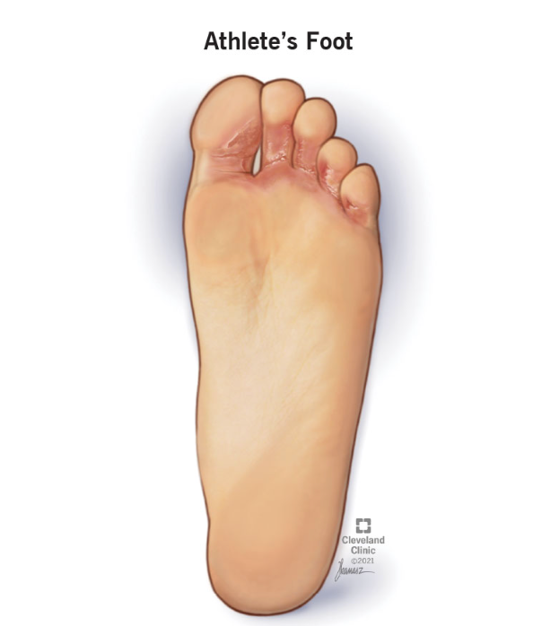 Hypochlorous Acid for Treating Athlete’s Foot: A Natural, Antimicrobial Solution