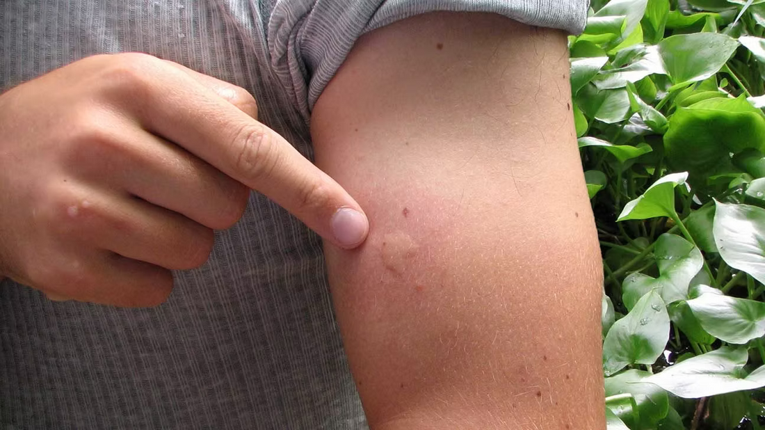 Hypochlorous Acid for Bug Bites: Quick, Natural Relief for Itchy Skin