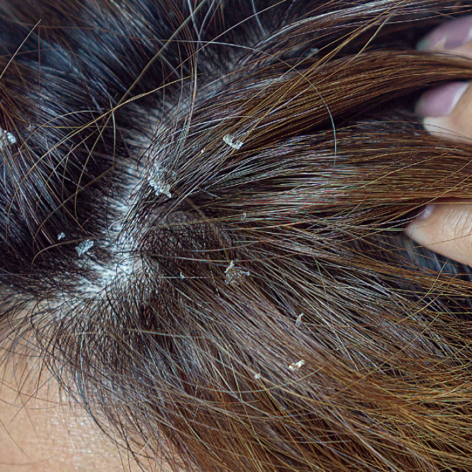 Hypochlorous Acid: Gentle Fix for Seborrheic Dermatitis