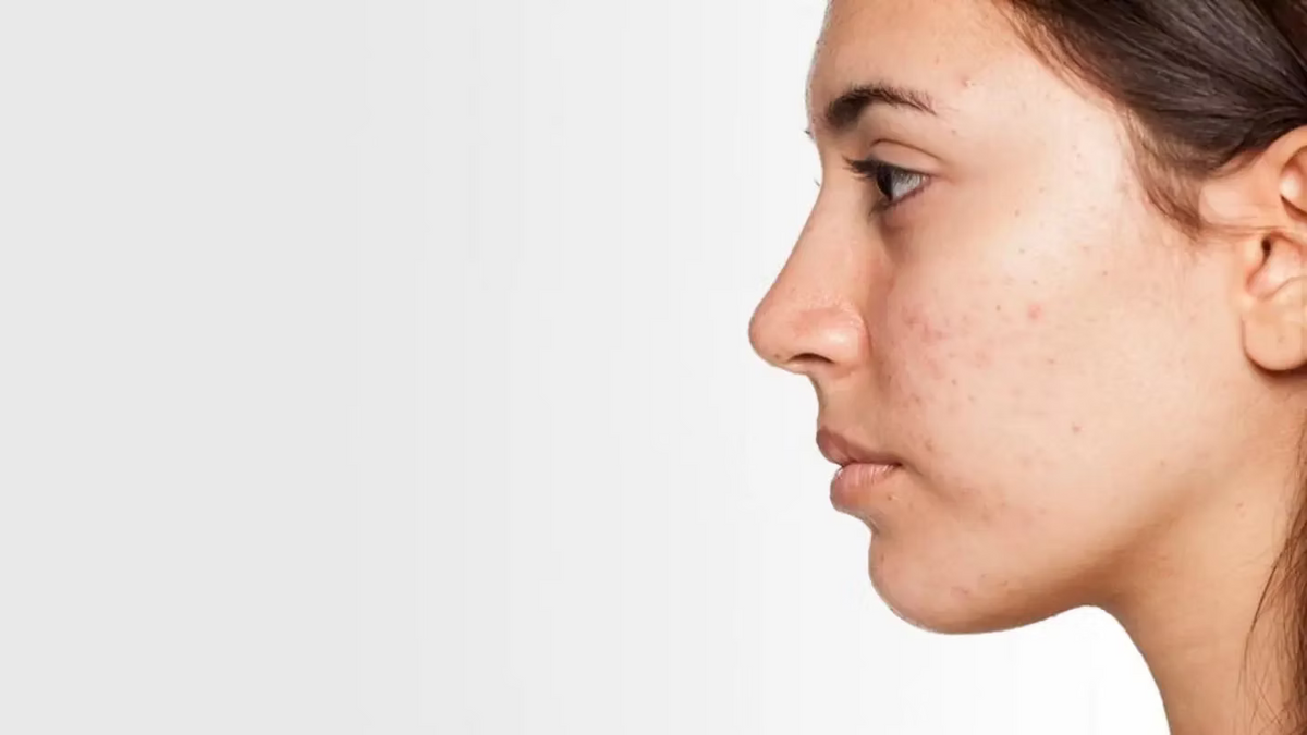 Can Hypochlorous Acid Cause Purging?