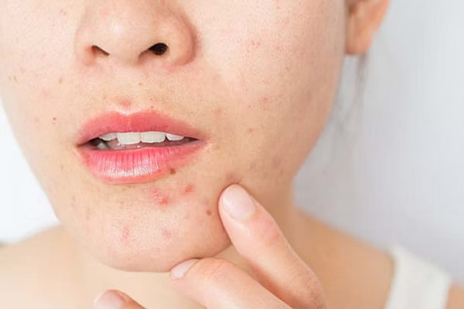 Does Hypochlorous Acid Help with Perioral Dermatitis?