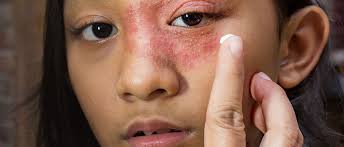 hypochlorous acid spray