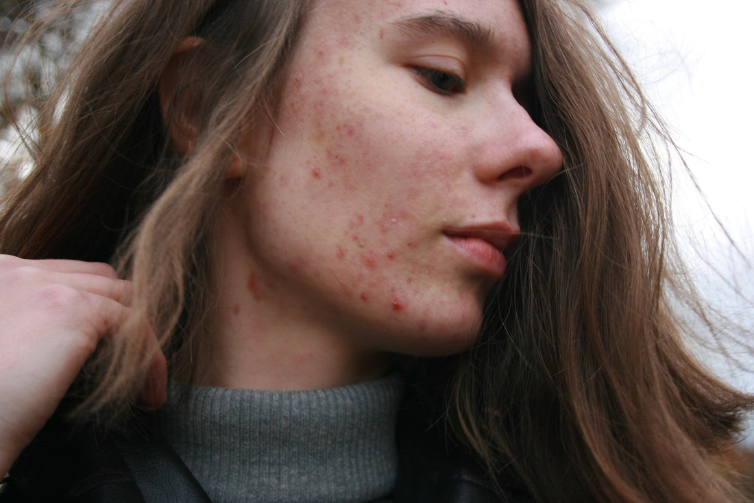 How Hypochlorous Acid Helps With Hormonal Breakouts?