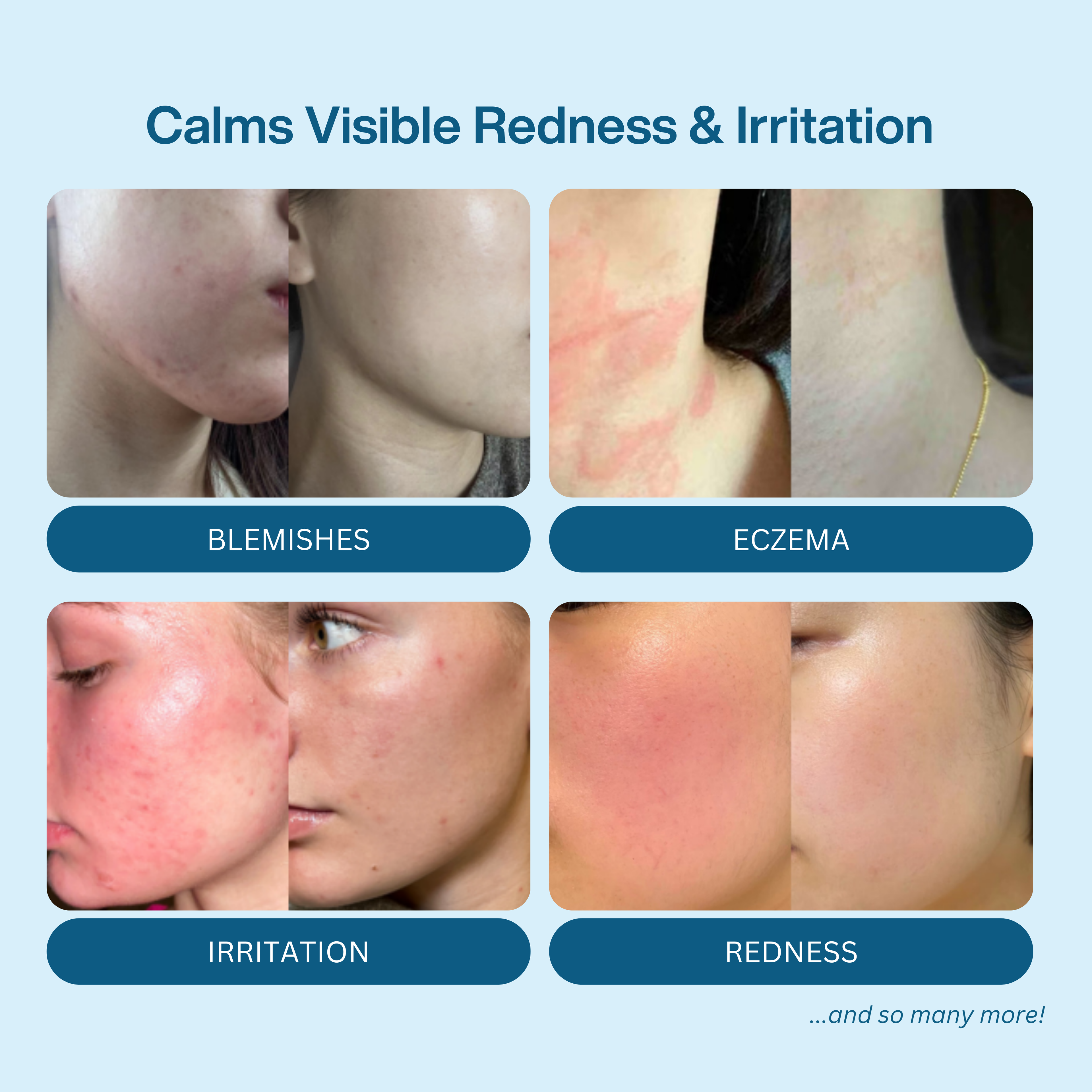 Hypochlorous Acid Spray